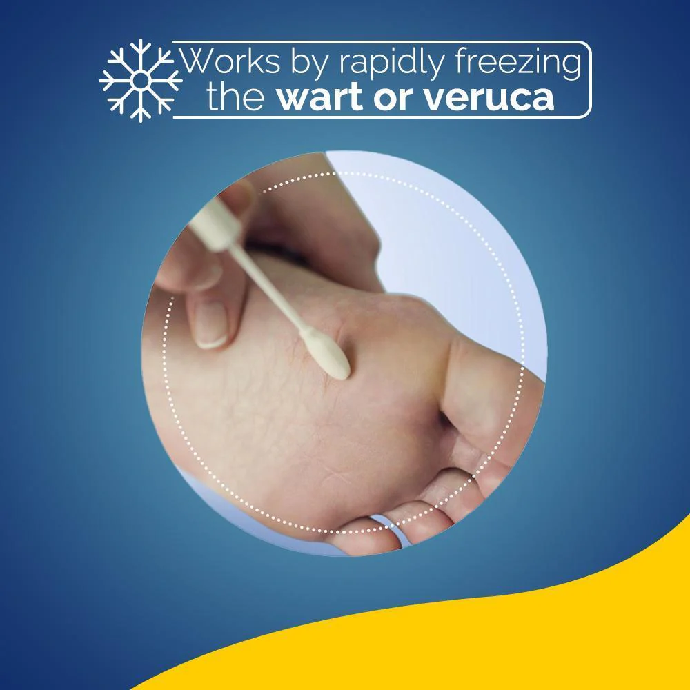 Wart Verruca Freeze Treatment - Image 10