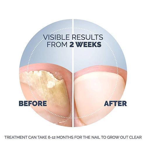 Fungal Nail Treatment - Image 7
