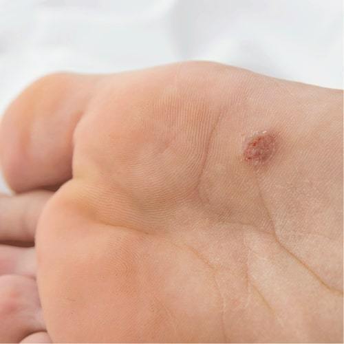 Wart & Verruca Complete Treatment Pen - Image 7